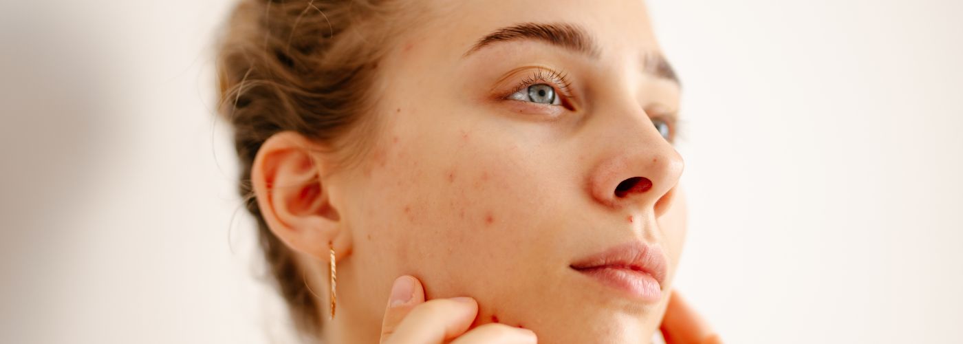Effects on Acne-Causing Bacteria and Inflammation
